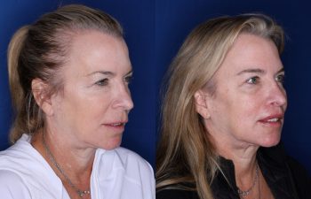 53 year old female 5 months post op from a modified subnasal lip lift