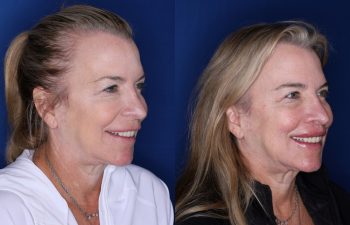 53 year old female 5 months post op from a modified subnasal lip lift