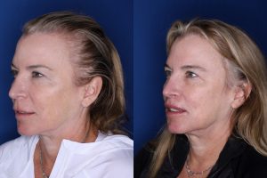 53 year old female 5 months post op from a modified subnasal lip lift
