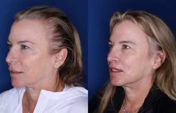 53 year old female 5 months post op from a modified subnasal lip lift