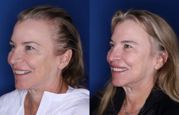 53 year old female 5 months post op from a modified subnasal lip lift