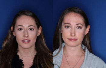 26 year old female 7 months post op following cosmetic rhinoplasty