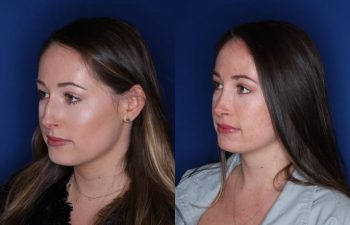 26 year old female 7 months post op following cosmetic rhinoplasty