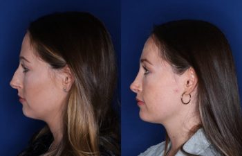 26 year old female 7 months post op following cosmetic rhinoplasty