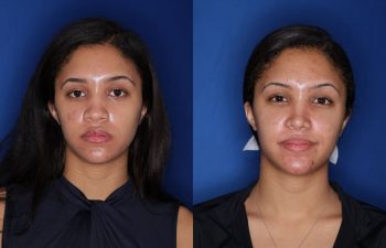 20 Year old female 3 months post cosmetic rhinoplasty with alar base nostril reductions