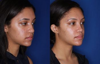 20 Year old female 3 months post cosmetic rhinoplasty with alar base nostril reductions