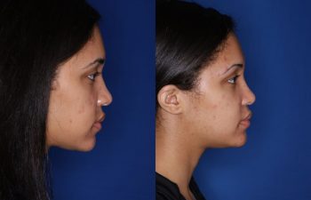 20 Year old female 3 months post cosmetic rhinoplasty with alar base nostril reductions