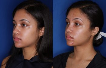 20 Year old female 3 months post cosmetic rhinoplasty with alar base nostril reductions