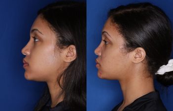 20 Year old female 3 months post cosmetic rhinoplasty with alar base nostril reductions