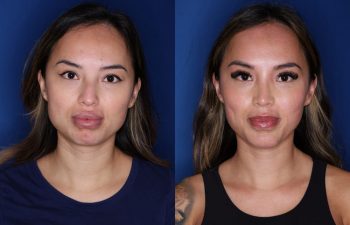 32 year old female 3 months post op from cosmetic rhinoplasty with chin implant