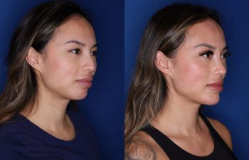 32 year old female 3 months post op from cosmetic rhinoplasty with chin implant