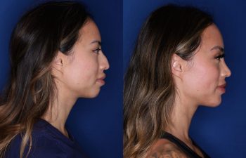 32 year old female 3 months post op from cosmetic rhinoplasty with chin implant