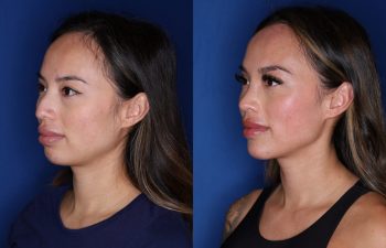 32 year old female 3 months post op from cosmetic rhinoplasty with chin implant