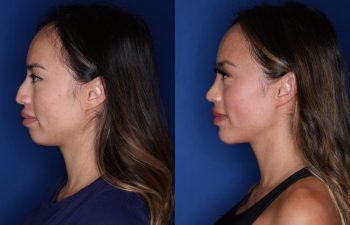 32 year old female 3 months post op from cosmetic rhinoplasty with chin implant