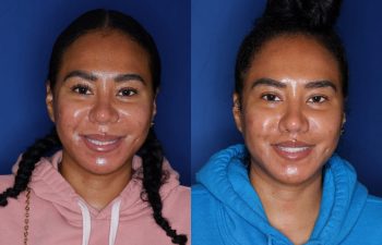 40 year old female 7 months post perialar lip lift