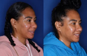 40 year old female 7 months post perialar lip lift