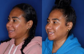 40 year old female 7 month post op from a subnasal lip lift