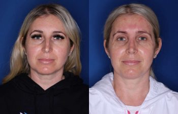 34 year old female 6 weeks following a cosmetic rhinoplasty - front view
