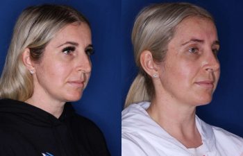 34 year old female 6 weeks following a cosmetic rhinoplasty - right side.