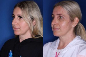 34 year old female 6 weeks following a cosmetic rhinoplasty - left side.