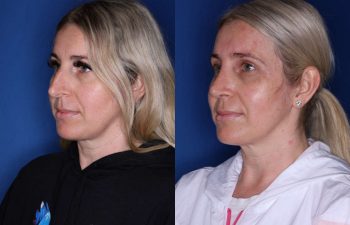 34 year old female 6 weeks following a cosmetic rhinoplasty - left side.