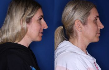 34 year old female 6 weeks following a cosmetic rhinoplasty - right side.