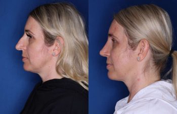 34 year old female 6 weeks following a cosmetic rhinoplasty - left side.