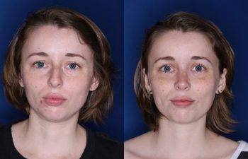 28 year old female 2 months post op from a cosmetic rhinoplasty