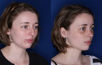 28 year old female 2 months post op from a cosmetic rhinoplasty