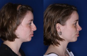 28 year old female 2 months post op from a cosmetic rhinoplasty