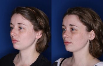 28 year old female 2 months post op from a cosmetic rhinoplasty