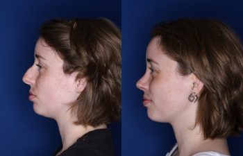 28 year old female 2 months post op from a cosmetic rhinoplasty