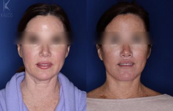 52 year old female 5 months post op following an extended deep plane facelift a modified bullhorn upper lip lift