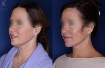 52 year old female 5 months post op following an extended deep plane facelift a modified bullhorn upper lip lift