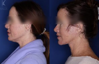 52 year old female 5 months post op following an extended deep plane facelift a modified bullhorn upper lip lift