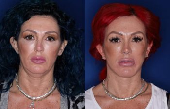 43 year old female 3 months following an extended deep plane mini facelift