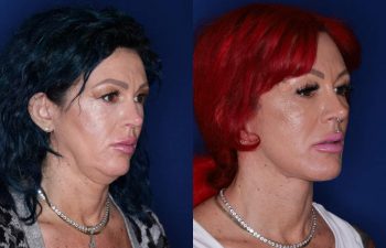 43 year old female 3 months following an extended deep plane mini facelift