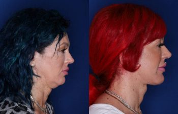 43 year old female 3 months following an extended deep plane mini facelift