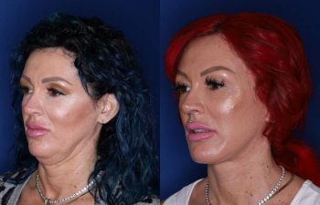 43 year old female 3 months following an extended deep plane mini facelift