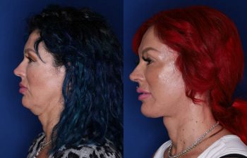43 year old female 3 months following an extended deep plane mini facelift