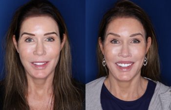 59 year old female 1 year post lip lift