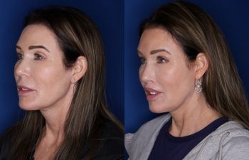 59 year old female 1 year post lip lift