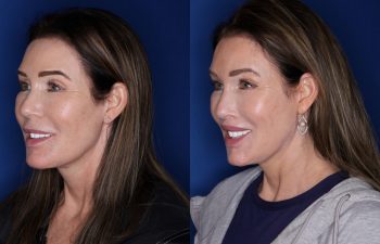 59 year old female 1 year post lip lift