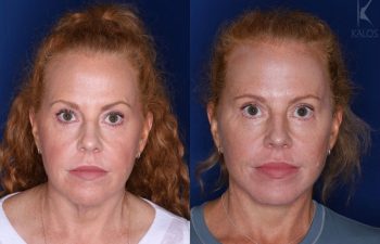 53 year old 3 months following upper and lower blepharoplasty and a mini extended deep plane facelift