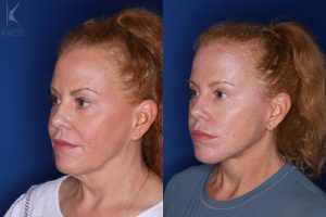 53 year old 3 months following upper and lower blepharoplasty and a mini extended deep plane facelift