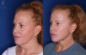 53 year old 3 months following upper and lower blepharoplasty and a mini extended deep plane facelift
