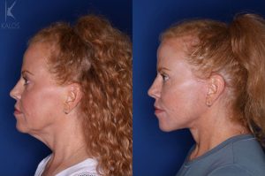 53 year old 3 months following upper and lower blepharoplasty and a mini extended deep plane facelift