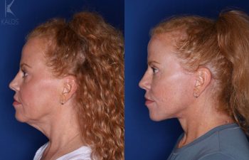53 year old 3 months following upper and lower blepharoplasty and a mini extended deep plane facelift