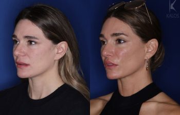 41 year old female almost 2 years out from a modified perialar lip lift