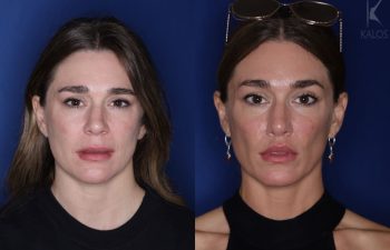 41 year old female almost 2 years out from a modified perialar lip lift